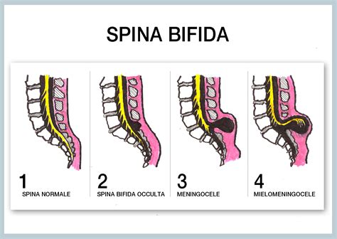 espinha bifida oculta cid 10